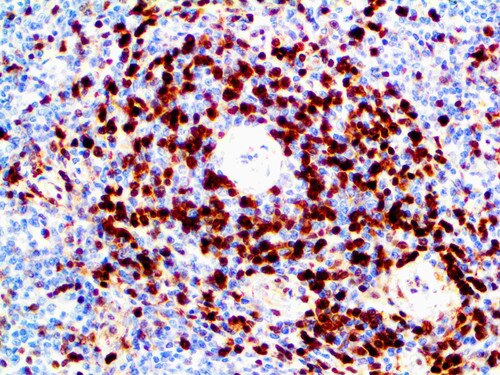 IHC of Annexin A1 on a FFPE Hairy Cell Leukemia Tissue